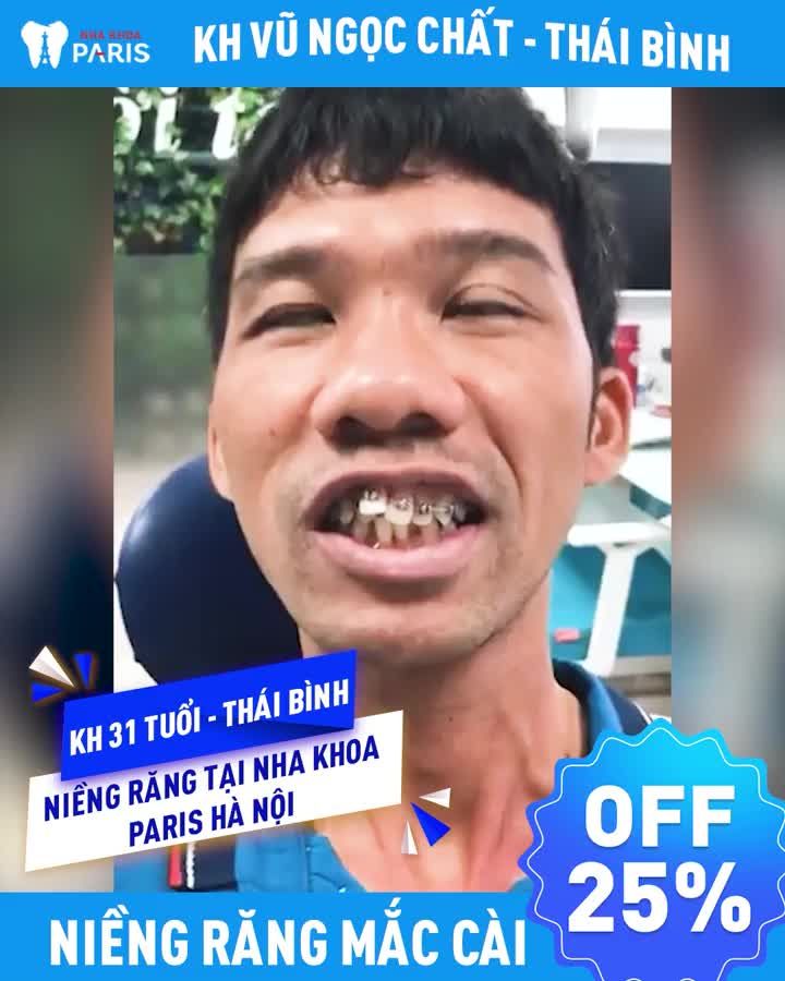 31 Tuổi Lựa Chọn Niềng Răng Mắc Cài